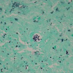 Fig. 2-B Permanent sections revealed granuloma formation and acute inflammation (Grocott-Gomori methenamine-silver nitrate stain).
