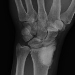 Fig. 4-A Anteroposterior radiograph, made at the time of the two-year follow-up, demonstrating the bone cement in the distal part of the radius, without evidence of recurrence of the infection.
