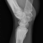 Fig. 4-B Lateral radiograph, made at the time of the two-year follow-up, demonstrating the bone cement in the distal part of the radius, without evidence of recurrence of the infection.
