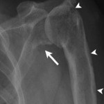 Fig. 1 Anteroposterior radiograph of the shoulder. Varus deformity of the proximal part of the humerus is evident. Erosions involving the scapular neck (arrow) and proximal part of the humerus (arrowheads) are seen.

