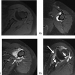 Fig. 3 Axial T1-weighted fat-suppressed magnetic resonance images without gadolinium injection (A) and with gadolinium injection (B, C, and D). A and D are at the level of the inferior part of the glenohumeral joint, B is at the level of the proximal part of the humeral diaphysis, and C is at the level of the axillary nerve. B shows enhancement of the mass surrounding the proximal part of the humerus. In C, enhanced mass (black arrowhead) is seen in contact with the axillary nerve (white arrow). Large erosions containing enhancing material are seen in D (short arrows). The mass encases the thin heterogeneous subscapularis (large arrow) and teres minor (arrowhead) tendons.
