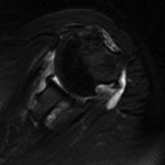Fig. 4 Axial T2-weighted fat-suppressed magnetic resonance images made at the middle-to-inferior aspect of the glenohumeral joint, demonstrating periarticular erosions and no evidence of fatty infiltration of the teres minor.

