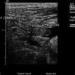 Fig. 3 Doppler venous ultrasound of the proximal right arm and shoulder was obtained to better visualize the area of concern.
