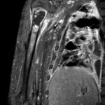 Fig. 4 T2-weighted magnetic resonance imaging scan of the proximal part of the humerus, revealing abscess formation in the proximal humeral metaphysis with marked periosteal reaction and subperiosteal fluid collection consistent with osteomyelitis as well as surrounding pyomyositis. There are many cavitary lesions in the right lung consistent with abscesses.
