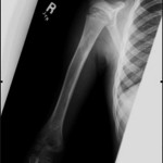 Fig. 5 Anteroposterior radiograph of the right humerus, demonstrating no damage to the proximal physis and showing radiographic changes consistent with healing osteomyelitis.
