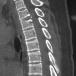 Fig. 3 Computed tomographic sagittal reconstruction, made at the fourteen-month follow-up examination, demonstrating complete resolution of the calcification within the intervertebral disc.

