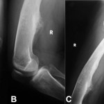 Fig. 1 Anteroposterior (Fig. 1-A) and lateral (Fig. 1-B) radiographs of the right knee show broad-based skeletal osteochondromas and enchondromas of the distal end of the femur and proximal end of the tibia and an osteolytic lesion of the lateral aspect of the proximal metaphysis of the right tibia. A lateral radiograph of the right femur (Fig. 1-C) shows skeletal osteochondromas, involving the lesser trochanter and distal femoral diaphysis, and a diaphyseal enchondroma.
