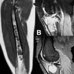 Fig. 3 Fig. 3-A — Coronal T2-weighted magnetic resonance imaging of the right femur shows an extensive diaphyseal enchondroma. Fig. 3-B — Sagittal T2-weighted magnetic resonance imaging of the right knee shows a proximal tibial enchondroma. Fig. 3-C — Sagittal T2-weighted magnetic resonance imaging of the right knee shows a destructive lesion of the lateral tibial condyle, with erosion of the anterior and lateral cortex, without an associated soft-tissue mass.
