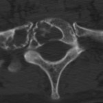 Fig. 1 Axial computed tomographic scan of the T1 vertebral body, made at the time of diagnosis, showing a lytic lesion with sclerotic borders within the T1 vertebral body and the first rib. 
