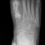 Fig. 2  Radiograph of the right foot, showing mottled destruction of the first metatarsal and osteopenia of the other bones.
