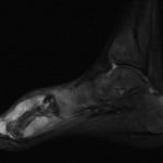 Fig. 3 T2-weighted sagittal magnetic resonance image showing a hyperintense lesion involving the right first metatarsal with hypointense areas due to sclerosis. Marrow edema is seen in the medial cuneiform and the proximal phalanx of the first digit.
