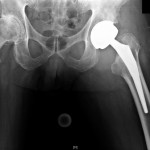 Fig. 1 Anteroposterior radiograph of the left hip.
