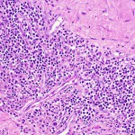 Fig. 3 Photomicrograph of a specimen of the periarticular inflammatory mass in the left hip, showing chronic inflammation with prominent perivascular lymphocytic aggregation (hematoxylin and eosin, ×400).
