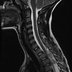 Fig. 1-A Sagittal T2-weighted magnetic resonance image with fat suppression, showing a large heterogeneous lesion in the posterior epidural space.
