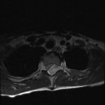 Fig. 1-B Axial T2-weighted magnetic resonance image with fat suppression, showing a large heterogeneous lesion, most consistent with an epidural hematoma, in the posterior epidural space.
