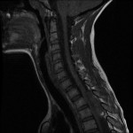 Fig. 1-C Sagittal T1-weighted magnetic resonance image with fat suppression, showing a large heterogeneous lesion in the posterior epidural space.
