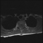 Fig. 1-D Axial T1-weighted magnetic resonance image with fat suppression, showing a large heterogeneous lesion in the posterior epidural space.

