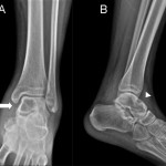 Fig. 1 Anteroposterior (Fig. 1-A) and lateral (Fig. 1-B) radiographs of the left ankle show a geographic osteolytic lesion with sclerotic margins involving the medial side of the left talus arrow and arrowhead).
