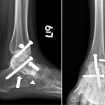 Fig. 5 Follow-up radiographs made nineteen months after the initial operation, showing successful osseous fusion across the tibiotalar, subtalar (arrow), and talonavicular (arrowhead) joints.
