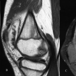 Fig. 1 Magnetic resonance images of the right knee. T1-weighted sagittal image (Fig. 1-A) revealing lobules within synovial thickening. T1-weighted sagittal image after gadolinium injection (Fig. 1-B), demonstrating marked synovial enhancement. Proton-density-weighted axial fat-suppressed image (Fig. 1-C) showing lobulated tissue in the suprapatellar pouch.

