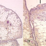 Fig. 2 Fig. 2-A Lobules of mature fat in the subsynovial tissue, leading to a polypoid appearance of the synovial membrane. Fig. 2-B There is mild hyperplasia of the synovial lining (arrows), and some inflammatory cells, lymphocytes, and plasma cells can be observed around capillaries.
