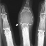 Fig. 2-A Anteroposterior (Fig. 2-A) and lateral (Fig. 2-B) radiographs of the long finger, showing a lytic, expansile lesion involving the majority of the middle phalanx, without visible internal matrix. Note the pathologic fracture (arrow) of the proximal articular surface.
