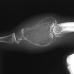 Fig. 2-B Anteroposterior (Fig. 2-A) and lateral (Fig. 2-B) radiographs of the long finger, showing a lytic, expansile lesion involving the majority of the middle phalanx, without visible internal matrix. Note the pathologic fracture (arrow) of the proximal articular surface.
