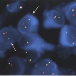 Fig. 6 Break-apart fluorescence in situ hybridization (FISH) study, with use of EWS (22q12) probe, showing several tumor cell nuclei (arrows) with widely separated red and green signals indicating the presence of an EWS-containing chromosomal translocation.
