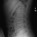 Fig. 4 Lateral lumbar radiograph showing a new vertebra plana at L5 one year after the initial presentation. The prior vertebra plana at T10 at the top of the image is grossly unchanged on radiographs.
