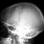 Fig. 5 Lateral radiograph of the skull, showing lytic lesions in the parietal and occipital regions.
