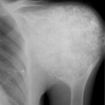 1 Anteroposterior radiograph of the left shoulder obtained in 1988, when the patient was twenty-seven years old.
