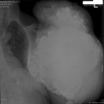 2 Anteroposterior radiograph of the left shoulder made in 2005, when the patient was forty-four years old.
