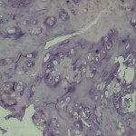 3 Photomicrograph of a histological sample from the tumor after excision (hematoxylin and eosin, ×100).
