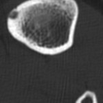 2 Axial CT image of the tibial metaphysis.

