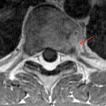 4-B T2-weighted axial magnetic resonance image, with gadolinium, demonstrating reactive soft-tissue swelling (arrow) to the left of the T7 vertebral body.

