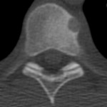 5-A Axial CT image demonstrating a 1-cm rounded lesion arising in the cortical margin of the left anterior T7 vertebral body. The adjacent vertebral body demonstrates reactive sclerosis with paraspinal soft-tissue swelling.
