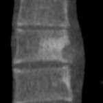 5-B Coronal reformatted image shows the vertebral body and paraspinal abnormalities. There is minimal reactive sclerosis of the adjacent anterior-superior part of the T8 vertebral body.
