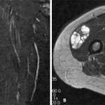 Fig. 1 Fig. 1-A Coronal STIR (short tau inversion recovery) MRI sequence of the right thigh shows a well-circumscribed lesion with surrounding edema in the vastus lateralis muscle. Fig. 1-B Axial T2-weighted TSE (turbo spin echo) MRI image through the center of the lesion shows the location of the lesion within the muscle.
