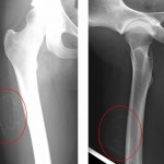 Fig. 2 Anteroposterior (left panel) and lateral (right panel) radiographs of the right thigh show the oval-shaped ossification within the soft tissue.
