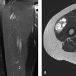 Fig. 3 Fig. 3-A T1-weighted FS (fat-suppressed) TSE MRI sequence after administration of gadolinium contrast medium shows a well-demarcated lesion with peripheral enhancement. Fig. 3-B T2-weighted TSE axial MRI sequence shows a well-demarcated lesion.
