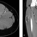 Fig. 4 Axial CT scan (Fig. 4-A) and coronal reconstruction of the lesion (Fig. 4-B) show a well-circumscribed soft-tissue mass with low density and peripheral ossification (“eggshell”).
