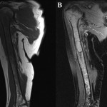 Fig. 1 T1-weighted (Fig. 1-A) and T2-weighted (with fat suppression) (Fig. 1-B) MRI sequences of the right shoulder, showing extensive intramedullary and some extramedullary edema and enhancement in the bone and periosteum extending into the soft tissue around the proximal part of the humerus.
