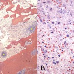 Fig. 2 Photomicrographs of an intraoperative bone specimen stained with hematoxylin and eosin (Fig. 2-A). 
