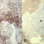 3 Photomicrographs of an intraoperative bone biopsy specimen from the proximal aspect of the right humerus show proliferation of T cells without abundant B cells (×40). Immunohistochemical staining for CD3 (T-cell marker) (Fig. 3-A) shows proliferation and aggregation of T cells (asterisk). Immunohistochemical staining for CD-20 (B-cell marker) (Fig. 3-B) shows sparse B cells (arrowhead). This indicates a reactive lymphocytosis rather than a conversion to lymphoma. Brown color indicates a positive stain.
