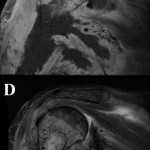 4 Three days after surgical drainage and biopsy, T1-weighted (top panel) and T2-weighted (with fat suppression) (bottom panel) MRI sequences reveal extensive intramedullary edema and enhancement, consistent with osteomyelitis, with a large intramedullary abscess measuring 2.0 × 1.5 × 7.3 cm in the craniocaudal dimension.
