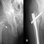 Fig. 1 Fig. 1-A Preoperative anteroposterior hip radiograph showing a right basicervical femoral neck fracture after the patient experienced a low-energy fall (arrows). Fig. 1-B Postoperative radiograph made at twenty-one months following closed reduction and internal fixation with an intramedullary nail
