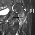 Fig. 2-B Coronal T2-weighted MRI scan showing a hypointense transverse line extending through the intertrochanteric area of the left hip, indicating a complete nondisplaced femoral fracture (arrow).
