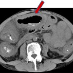 Fig. 2 A CT scan of the abdomen and pelvis demonstrated mucous-membrane thickening (arrow) and edema of the entire colon.
