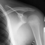 Fig. 2 Anteroposterior radiograph of the left shoulder reveals a soft-tissue radiodensity in the axillary region (arrows). The humeral head appears inferiorly subluxated.
