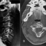Fig. 1 Fig. 1-A Preoperative imaging: Lateral cervical spine radiograph illustrating the lytic, expansile nature of the lesion of C2. Fig. 1-B Axial CT scan of C2 showing destruction of the anterior cortex, right lamina, and transverse process without soft-tissue involvement or neural compression.
